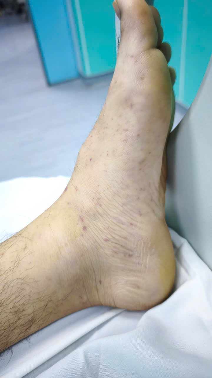 Ban xuất huyết do viêm não mô cầu - Ảnh BVCC