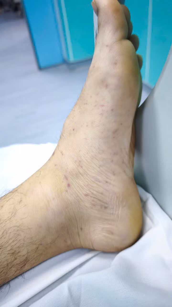 Ban xuất huyết do viêm não mô cầu - Ảnh BVCC