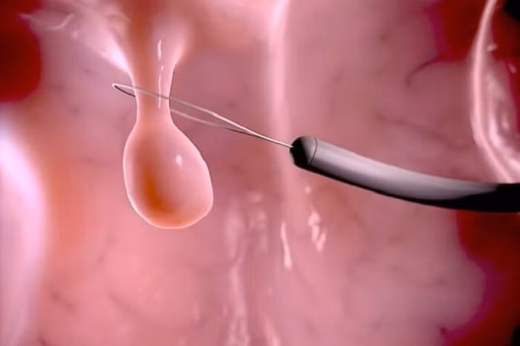 Cắt polyp dạ dày - Ảnh BVCC