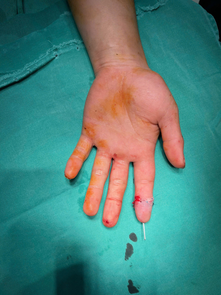 Ngón tay được vi phẫu nối thành công - Ảnh BVCC