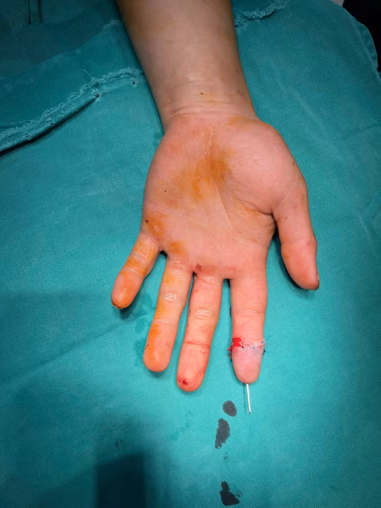 Ngón tay được vi phẫu nối thành công - Ảnh BVCC