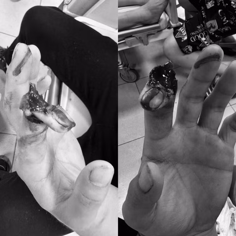 Đốt tay ngón trỏ bị đứt rời - Ảnh BVCC