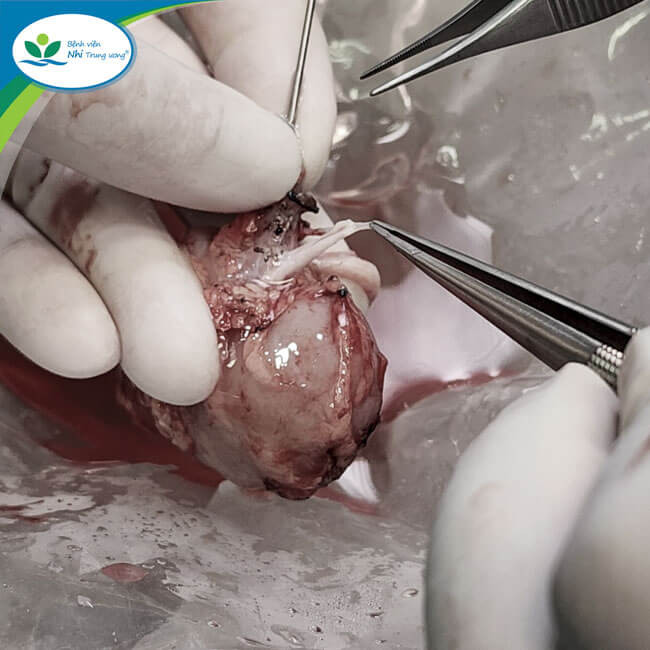 Các bác sĩ tạo hình động mạch thận cho bệnh nhi