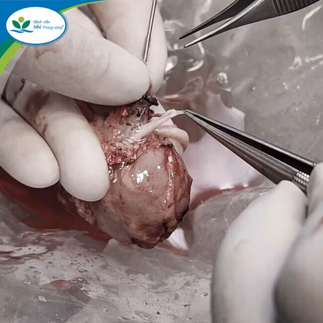 Các bác sĩ tạo hình động mạch thận cho bệnh nhi