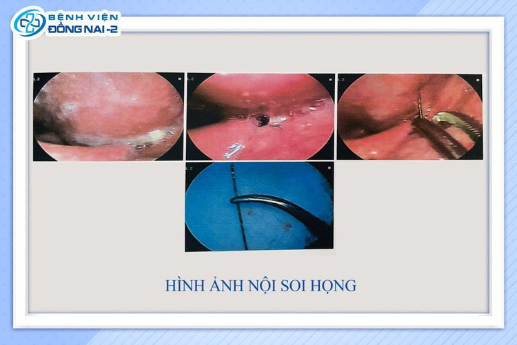Hình ảnh chiếc kim khâu dài 4 cm trong họng cụ ông 72 tuổi