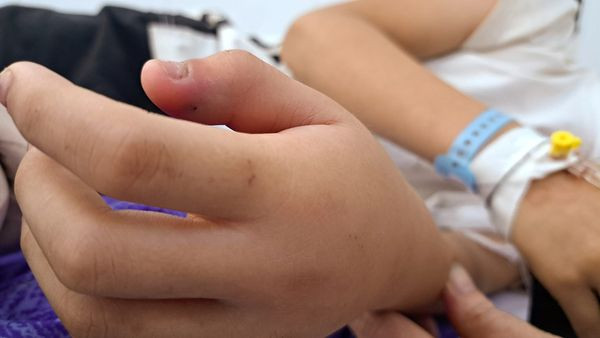 Rắn hổ mèo bò vào nhà nhiều trẻ bị cắn nhiễm độc toàn thân ảnh 1