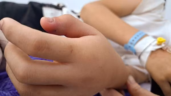 Rắn hổ mèo bò vào nhà nhiều trẻ bị cắn nhiễm độc toàn thân ảnh 1