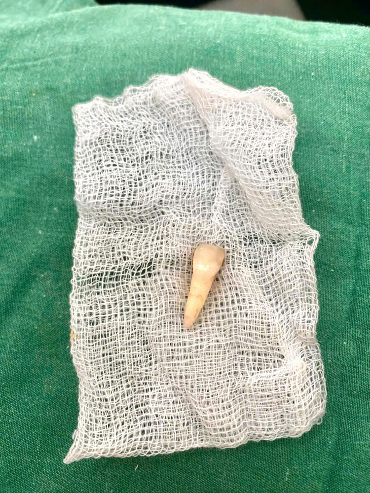 Chiếc răng bị rơi ra do tai nạn của bệnh nhân - Ảnh BVCC