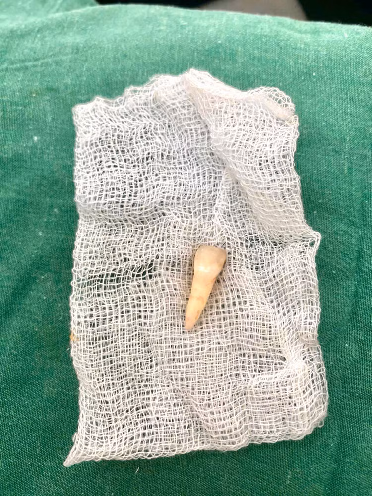 Chiếc răng bị rơi ra do tai nạn của bệnh nhân - Ảnh BVCC