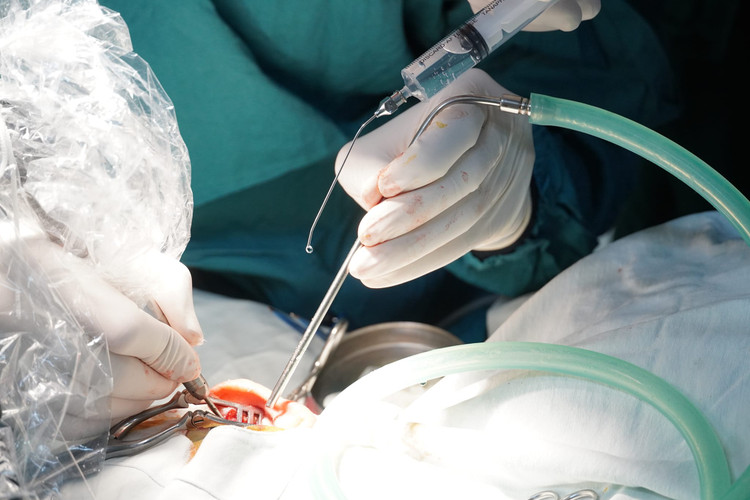 Tạo hình màng nhĩ do viêm tai giữa - Ảnh BSCC