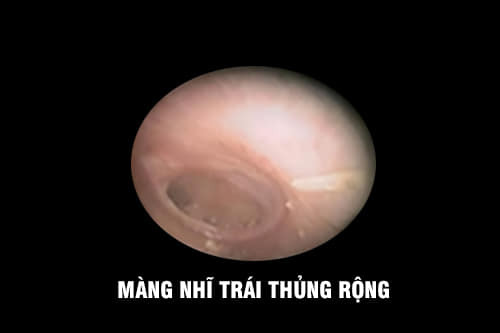 Màng nhĩ trái thủng rộng do viêm tai giữa - Ảnh BVCC
