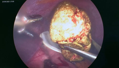 Ăn 5 quả hồng, phụ nữ 37 tuổi bị tắc ruột do u bã thức ăn ảnh 2