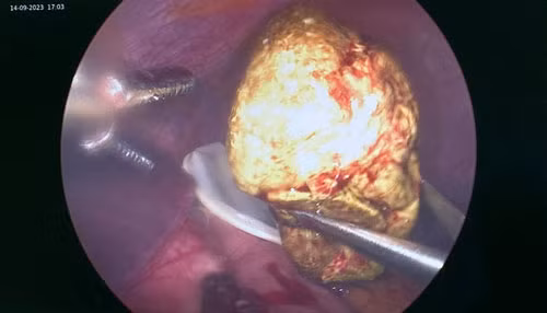 Ăn 5 quả hồng, phụ nữ 37 tuổi bị tắc ruột do u bã thức ăn ảnh 2