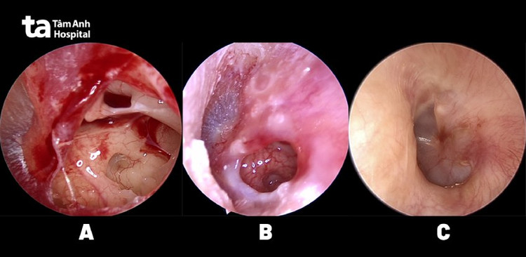 Hình ảnh nội soi tai vào thời điểm thủng màng nhĩ (hình A) – 10 ngày sau khi điều trị thủng nhĩ (hình B) và màng nhĩ lành hẳn sau 3 tuần (hình C) Ảnh: Bệnh viện Tâm Anh