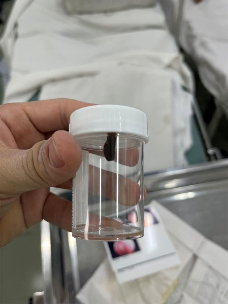 Dị vật (con vắt) sau khi được lấy ra