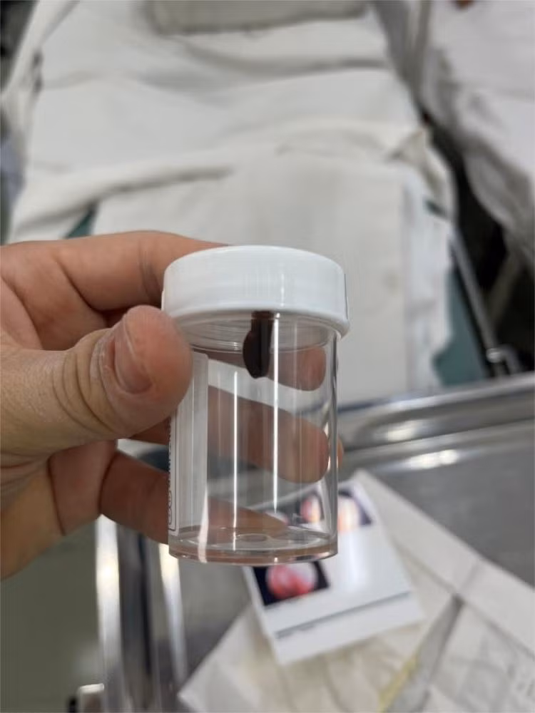 Dị vật (con vắt) sau khi được lấy ra