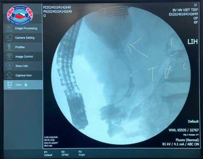 Chụp mật tuỵ ngược dòng có thuốc cản quang, ống mật chủ giãn ~ 26mm, kèm hình ảnh cắt cụt do khối u đè vào OMC thuốc cản quang không lưu thông xuống tá tràng được)