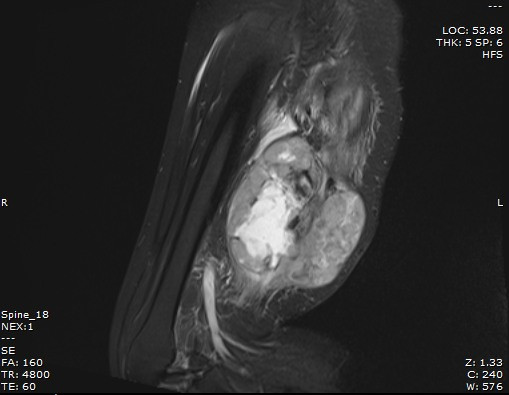 Kết quả chụp cộng hưởng từ (MRI) tại Bệnh viện Bãi Cháy xác định trong cơ vùng đùi phải có khối kích thước lớn 12,5x9,7cm