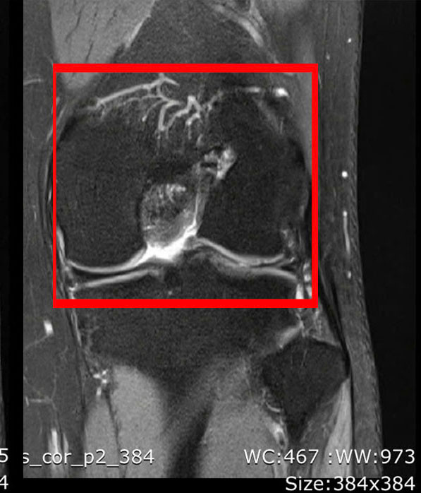 Tái tạo dây chằng chéo lần 3, mang lại hy vọng cho nhiều bệnh nhân ảnh 3