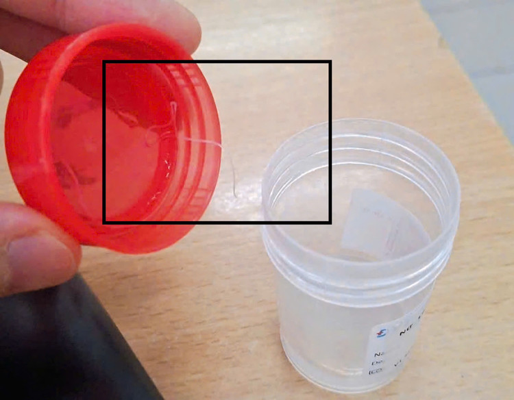 Ký sinh trùng được lấy ra từ mắt bệnh nhân - Ảnh BVCC