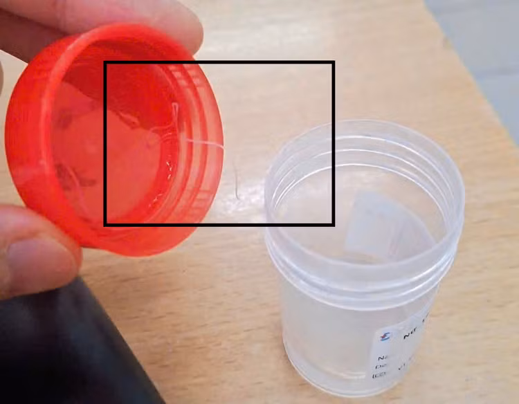 Ký sinh trùng được lấy ra từ mắt bệnh nhân - Ảnh BVCC