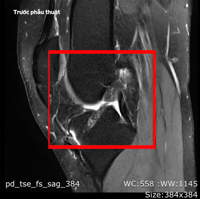 Tái tạo dây chằng chéo lần 3, mang lại hy vọng cho nhiều bệnh nhân ảnh 2