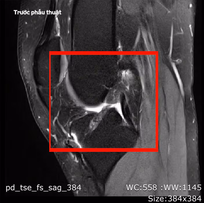 Tái tạo dây chằng chéo lần 3, mang lại hy vọng cho nhiều bệnh nhân ảnh 2 Tái tạo dây chằng chéo lần 3, mang lại hy vọng cho nhiều bệnh nhân ảnh 2