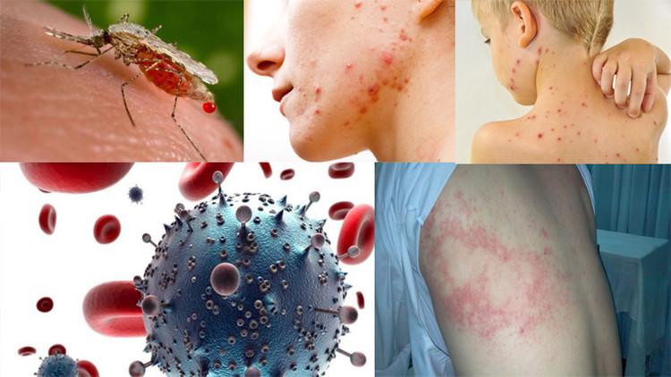 Các bệnh truyền nhiễm gia tăng - Ảnh minh họa