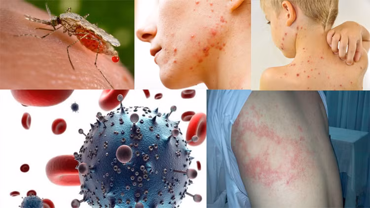 Các bệnh truyền nhiễm gia tăng - Ảnh minh họa Các bệnh truyền nhiễm gia tăng - Ảnh minh họa