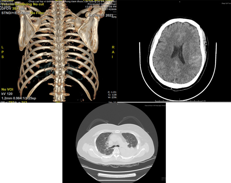 Hình ảnh chấn thương lồng ngực, sọ não, thận của bệnh nhân trên phim chụp CTscanner
