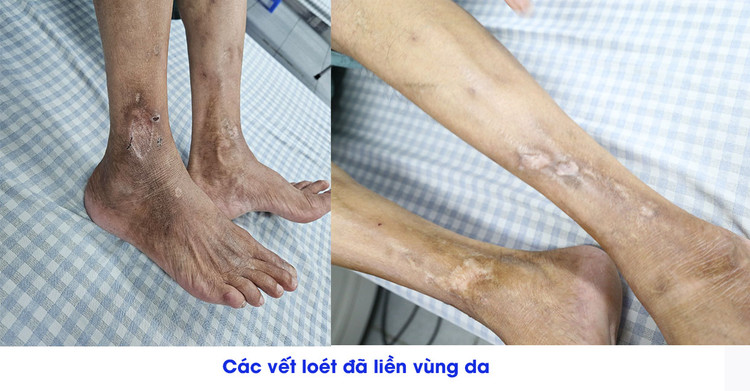 Sau can thiệp 2 tháng các vết loét đã hồi phục hoàn toàn.