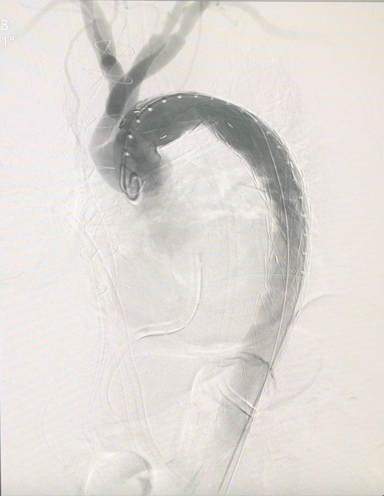 Hình ảnh lóc tách động mạch chủ sau can thiệp