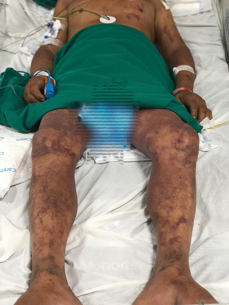 Bệnh nhân nguy kịch vì nhiễm liên cầu khuẩn lợn