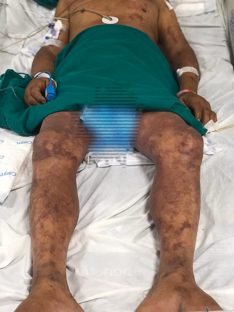 Bệnh nhân nguy kịch vì nhiễm liên cầu khuẩn lợn