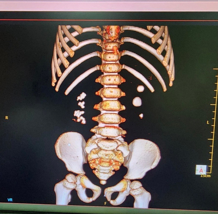 Hình ảnh sỏi thận 2 bên trên phim chụp