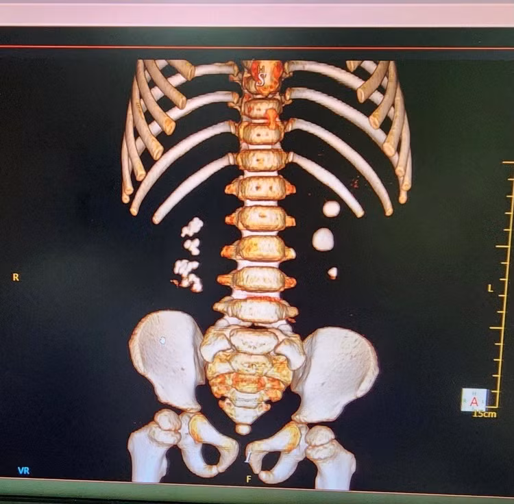 Hình ảnh sỏi thận 2 bên trên phim chụp