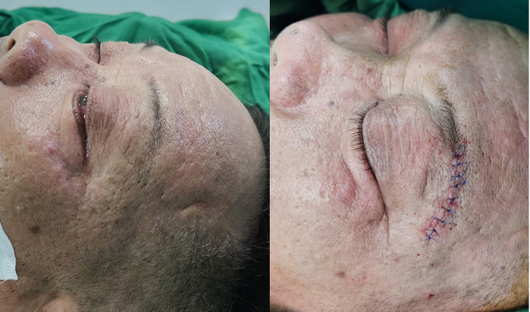 Ảnh trước mổ mắt nhắm không kín(ảnh bên trái) và ảnh sau mổ mắt nhắm kín (ảnh bên phải)