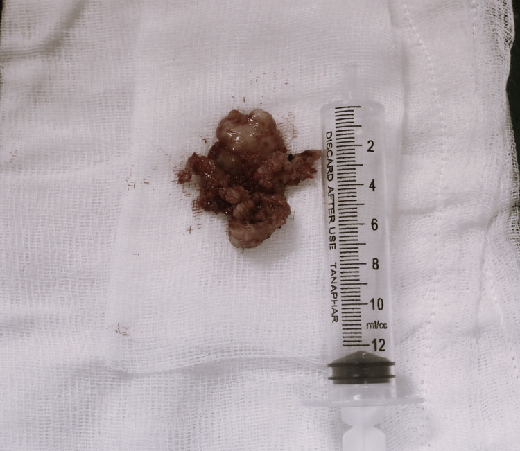 Khối u được lấy ra khỏi hốc mắt