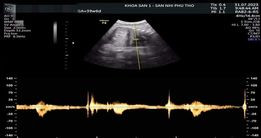 Hình ảnh tim thai đập rời rạc ngay khi mẹ vừa lên bàn siêu âm