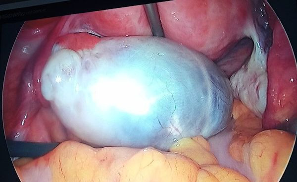 Khối u nang buồng trứng khổng lồ được bóc tách nội soi