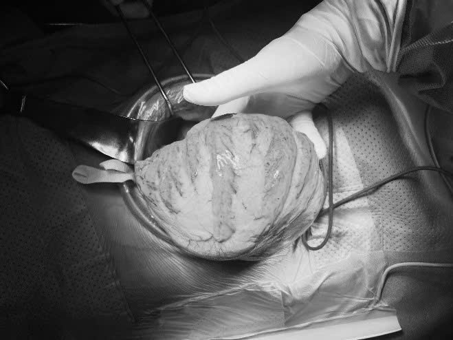 Ca phẫu thuật lấy khối phình cho bệnh nhân - Ảnh BVCC