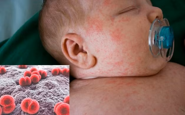 Vi khuẩn não mô cầu dễ tấn công trẻ nhỏ - Ảnh minh họa