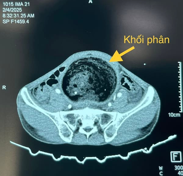 Khối phân tích tụ gây phình đại tràng - Ảnh BVCC