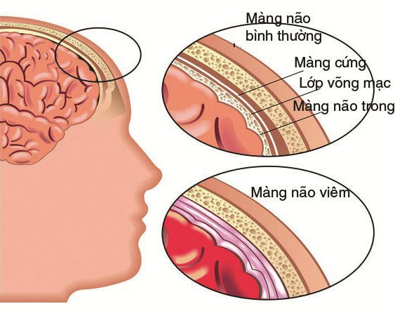 Viêm não mô cầu - Ảnh minh họa