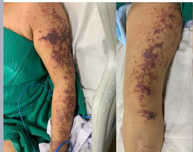 Ăn lòng lợn, người phụ nữ 59 tuổi sốc nhiễm khuẩn do mắc liên cầu lợn nguy kịch