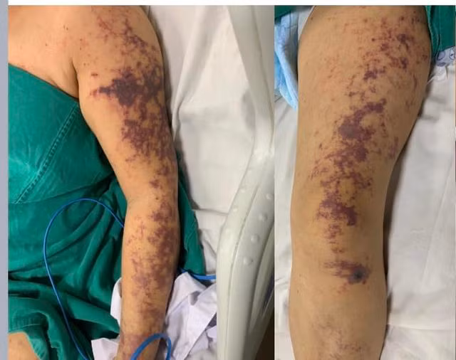 Ăn lòng lợn, người phụ nữ 59 tuổi sốc nhiễm khuẩn do mắc liên cầu lợn nguy kịch