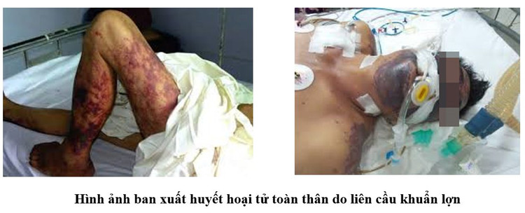 Bệnh nhân nguy kịch sau ăn tiết canh