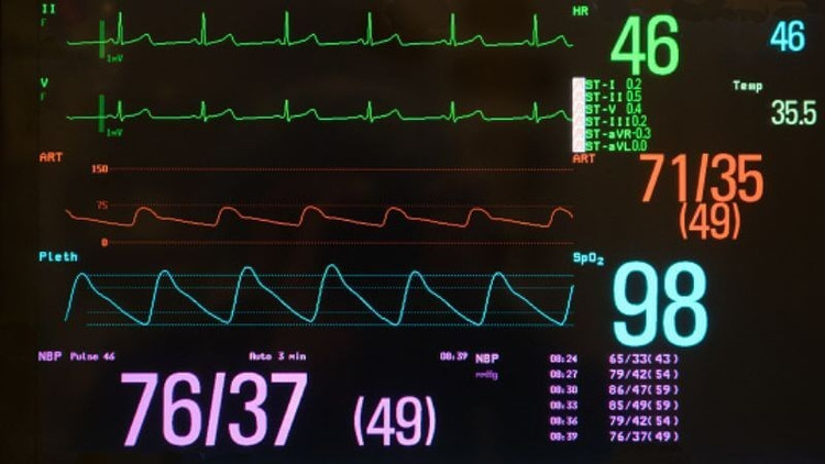Nhịp tim chậm trên máy theo dõi - Ảnh minh họa
