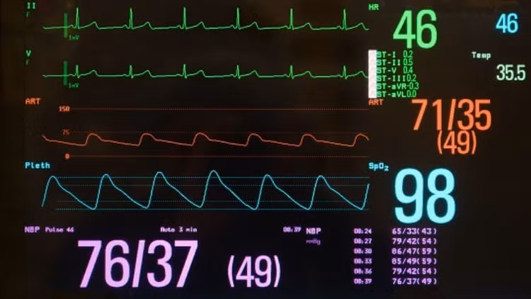 Nhịp tim chậm trên máy theo dõi - Ảnh minh họa