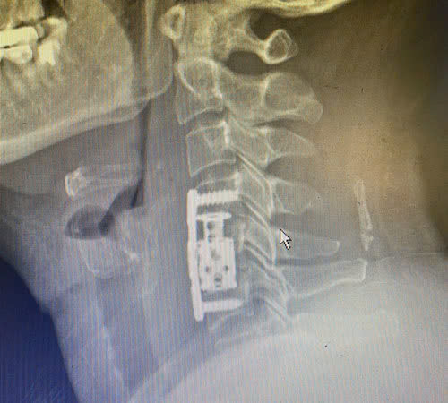 Hình ảnh vùng đốt sống cổ của người bệnh sau khi được thay đốt sống cổ nhân tạo